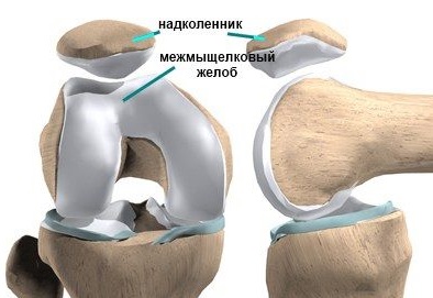 Хондромаляция надколенника5