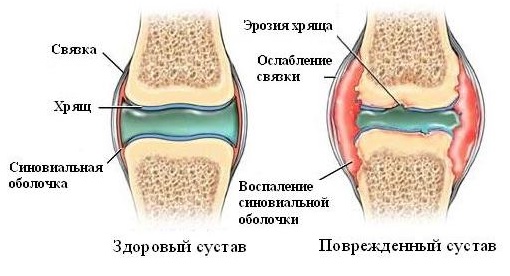 Поражение синовиальной оболочки5