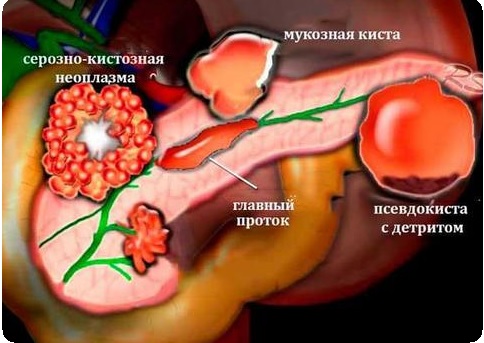 Ложная киста поджелудочной железы5