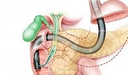 Эндоскопическая папиллосфинктеротомия