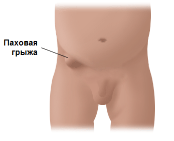 Эндоскопипческая операция по удалению грыжи5