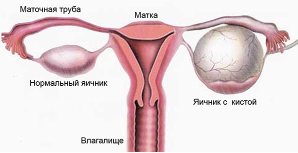 Почему после секса болят яичники5