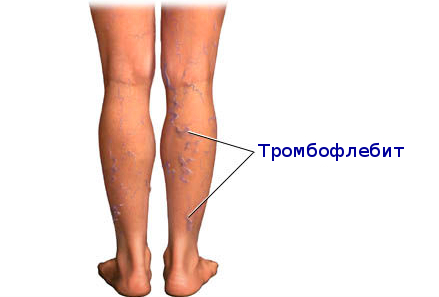 Почему болят ноги при ходьбе4