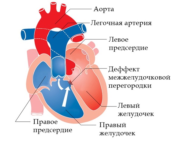 Клиника дефекта межжелудочковой перегородки5