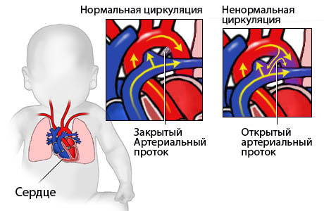 Классификация врожденных пороков сердца5