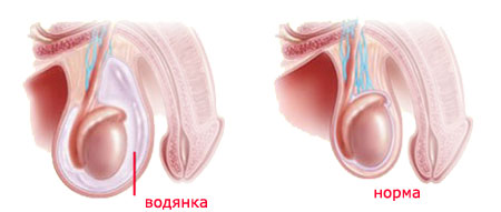 Водянка яичка у мужчин5