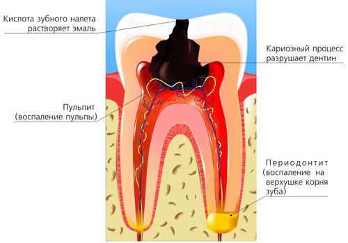 Периодонтит: симптомы, лечение5