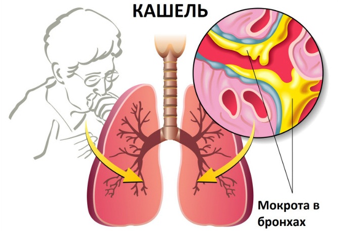 Причины мокроты5
