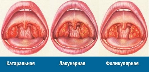 Фолликулярная ангина: причины, симптомы, лечение5
