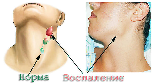 Паховый лимфаденит: причины, симптомы, лечение5