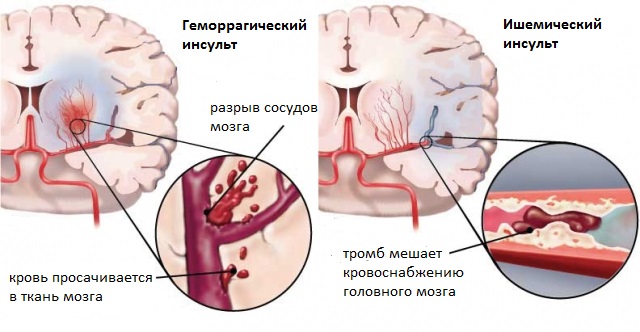 Инсульт у мужчин и женщин. Отличие, последствия.5