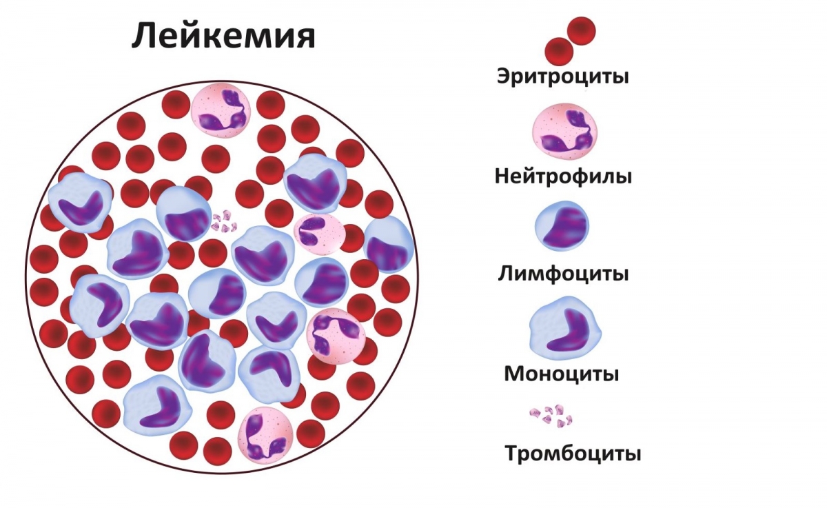 Заболевания крови у детей5