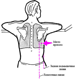 Пневмоперитонеум5