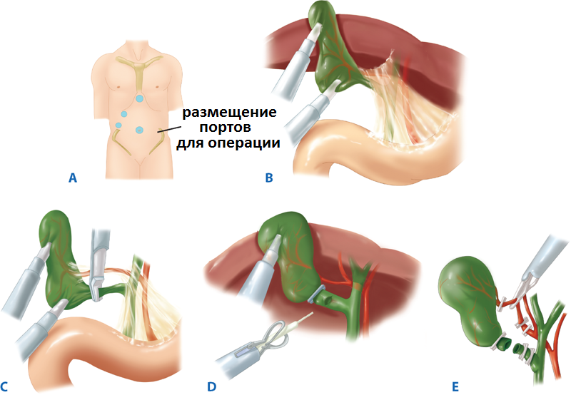 Опухоли желчных протоков6