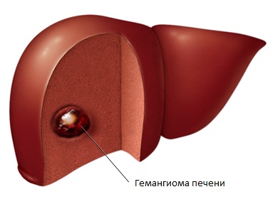 Киста печени: причины, лечение, диагностика, последствия6