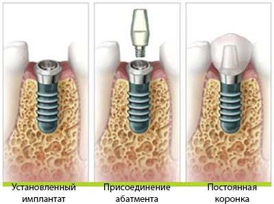 Нагрузки на дентальные имплантаты6