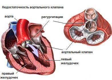 Атриовентрикулярный септальный дефект6