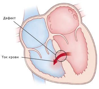 Клиника дефекта межжелудочковой перегородки6
