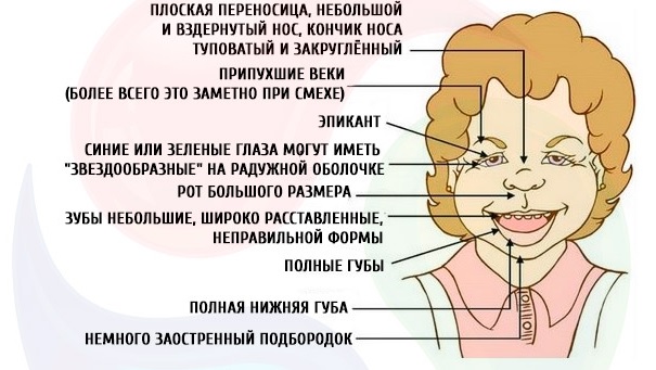 Врожденные пороки сердца6