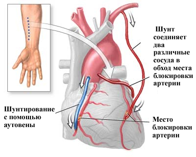 Врожденный дефект межжелудочковой перегородки6