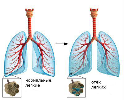 Морфология легочной гипертензии6