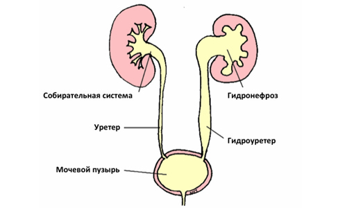 Песок в почках: причины, симптомы, лечение6