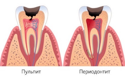 Периодонтит: симптомы, лечение6