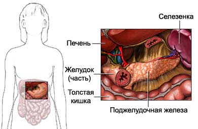 Панкреонекроз6