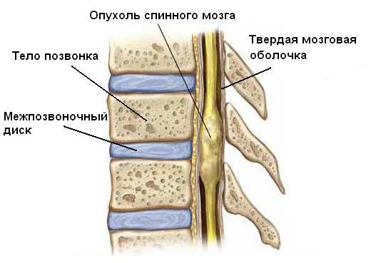 Боли в спине, отдающие в ногу: лечение6