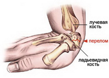 Переломы дистальных метаэпифизов костей предплечья7