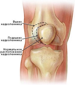 Хондромаляция надколенника7