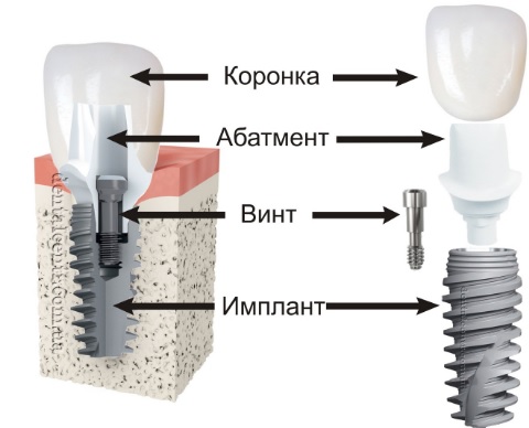 Винтовые протезы7