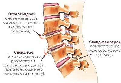 Почему болят ноги при ходьбе7