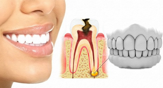 Периодонтит: симптомы, лечение7