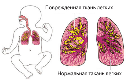 Анестезия новорожденных7