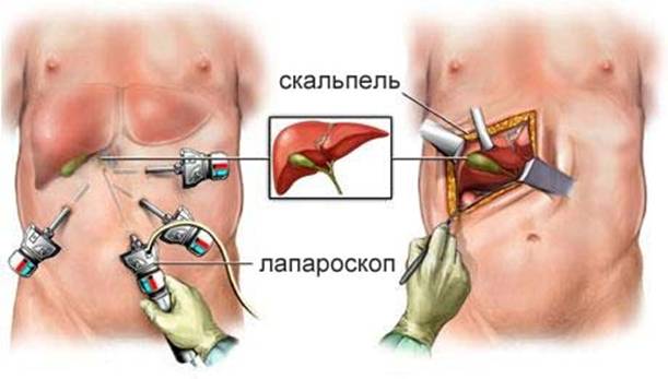Паразитарные заболевания печени8