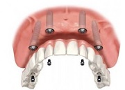 Несъемные протезы с опорой на имплантаты