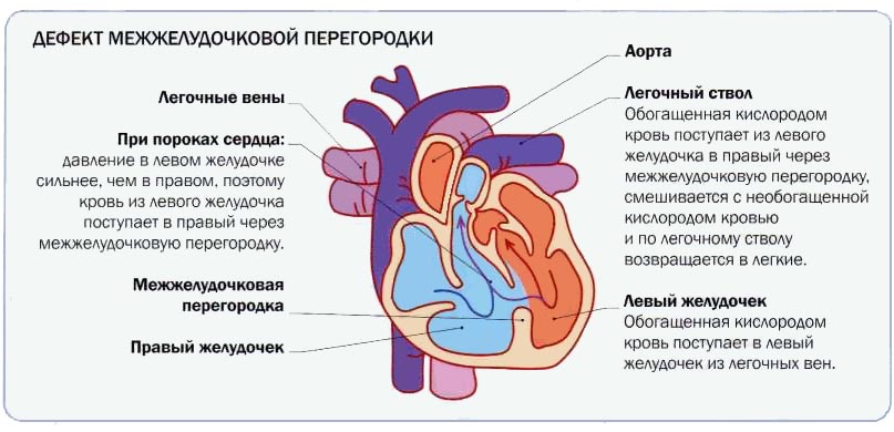 Классификация врожденных пороков сердца9
