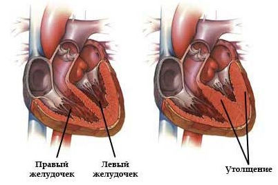 Единственный желудочек сердца8