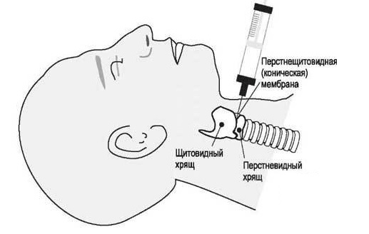 Эпиглотит. Ангина Людвига8