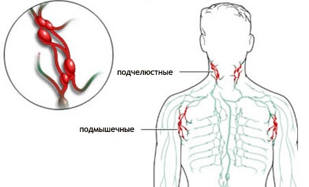 Лимфаденит8