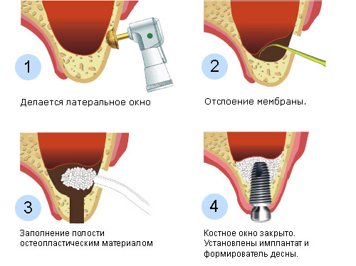 Задние отделы верхней челюсти9
