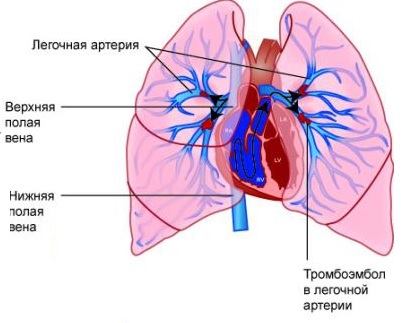 Перерыв дуги аорты у новорожденных9