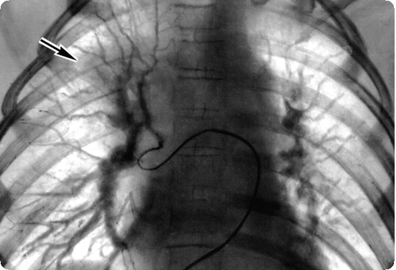 Пороки трехстворчатого клапана9