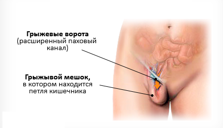 Паховая грыжа у женщин: симптомы, лечение, операция, фото1