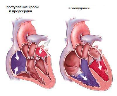 Подклапанный стеноз аорты10