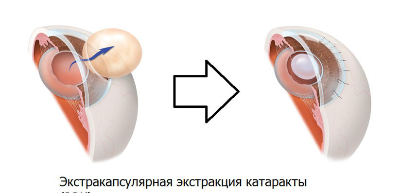 Катаракта глаз: симптомы, лечение, причины, операции, профилактика10