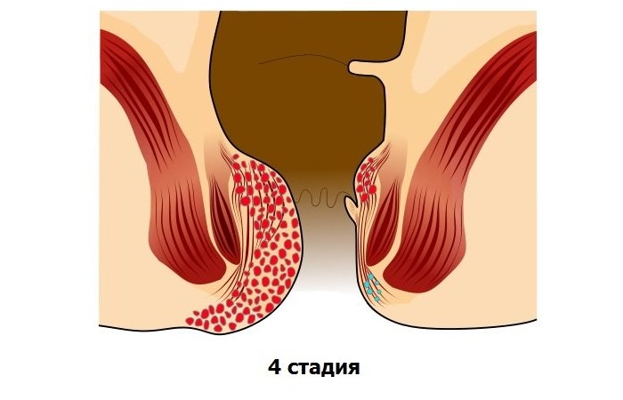 Внутренний геморрой: симптомы, лечение, причины возникновения10