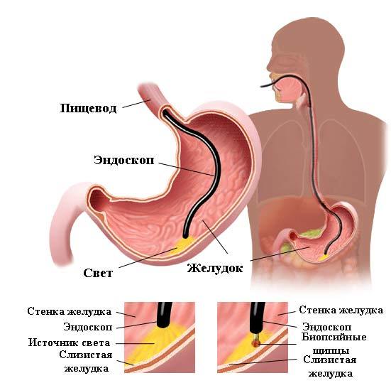 Рак желудка: симптомы, лечение, 1,2,3,4 стадии10