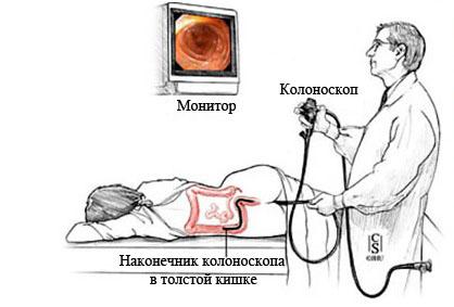Язвенный колит: симптомы, лечение: болезнь и диета10
